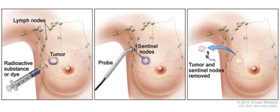 Sentinel-lymph-node-biopsy-article